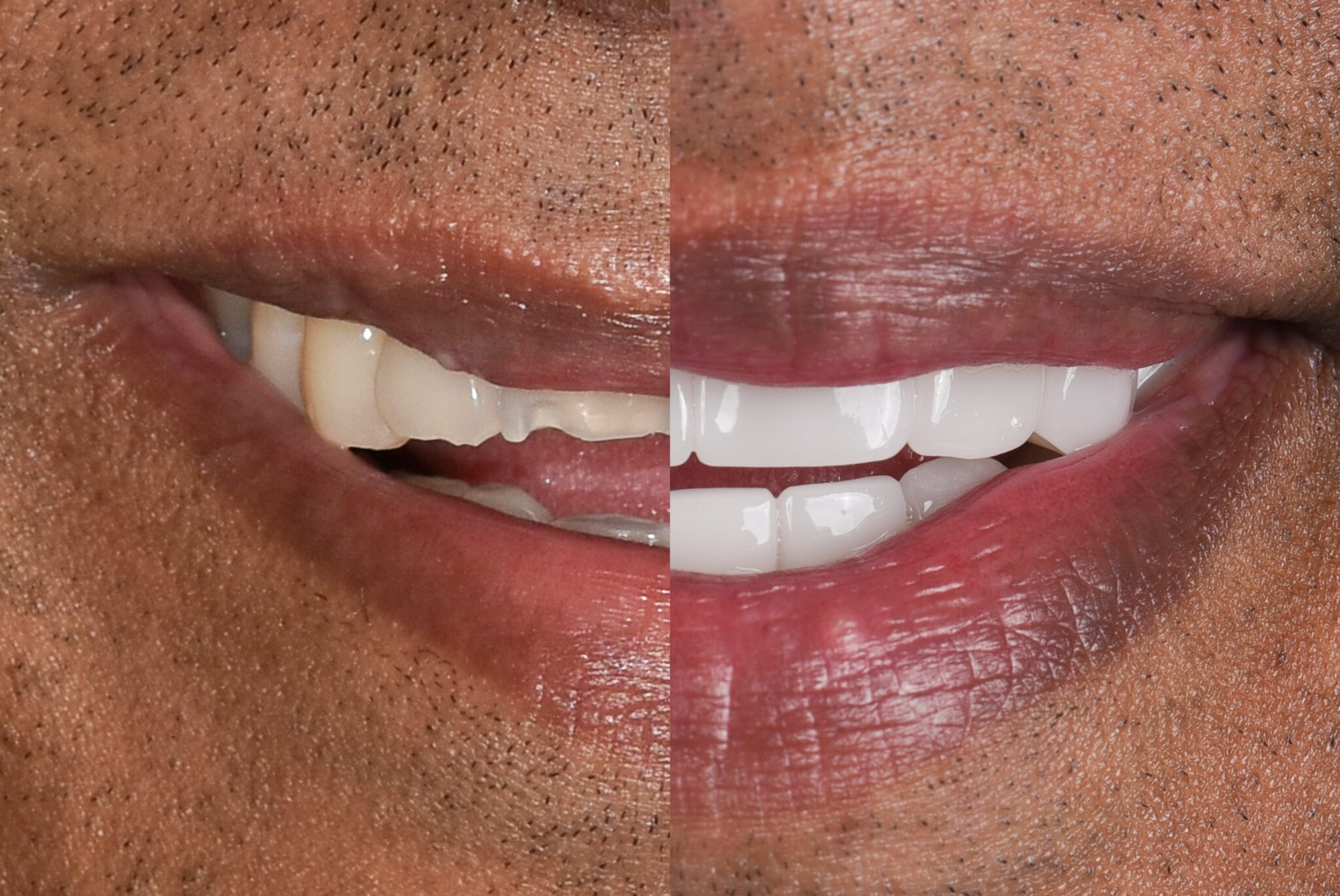 Before and After Pic-Dr Terence Moodley-Thinc Clinic