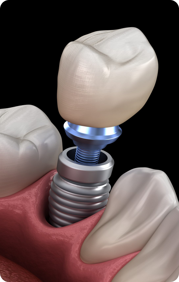 Thinc-9 70-Dental-Implants-Johannesburg