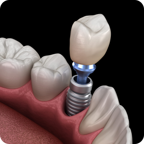 Thinc-9 913-Dental-Implants-Johannesburg
